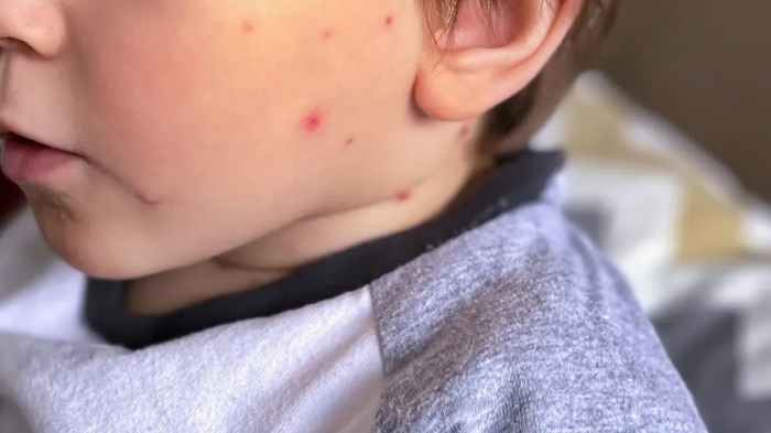 Не си струва рискът от варицела