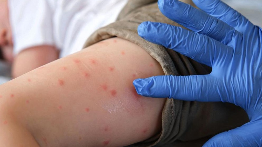 Нови случаи на морбили в Ловешко