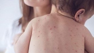 България е на първо място в Европа по регистрирани случаи на морбили, в кои области са най-много